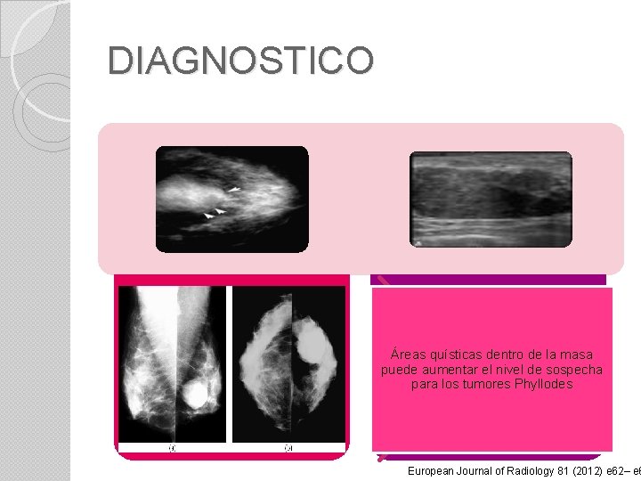 DIAGNOSTICO Masto • No es especifica • Lesión definida • Halo perilesional • Redondeada