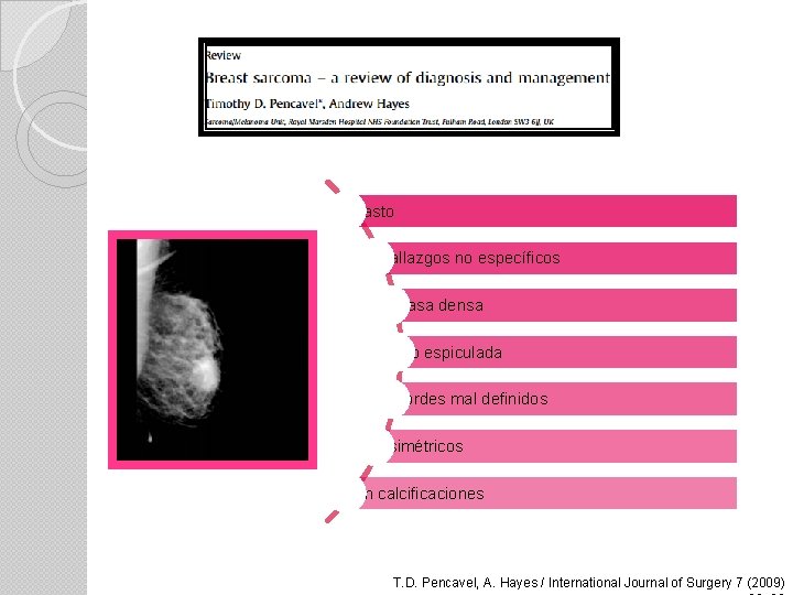 Masto Hallazgos no específicos Masa densa No espiculada Bordes mal definidos Asimétricos Sin calcificaciones