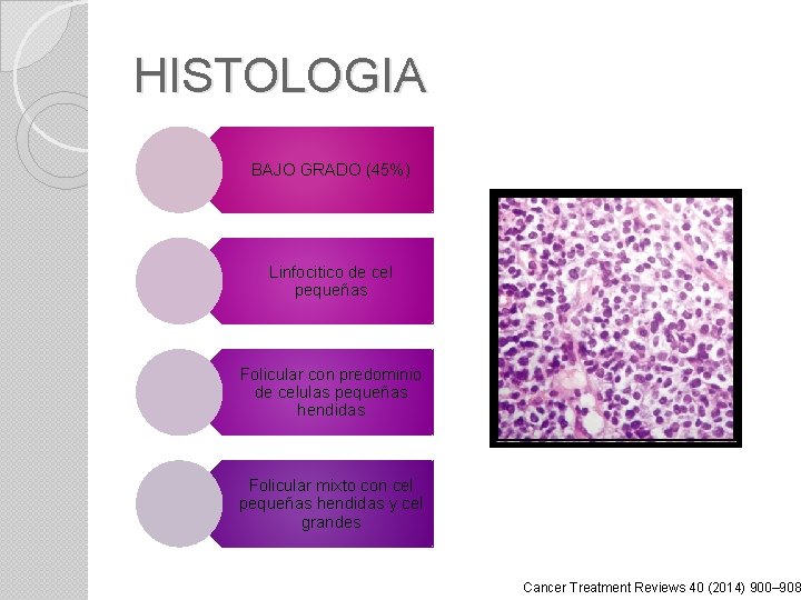 HISTOLOGIA BAJO GRADO (45%) Linfocitico de cel pequeñas Folicular con predominio de celulas pequeñas