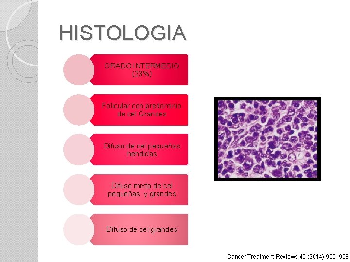 HISTOLOGIA GRADO INTERMEDIO (23%) Folicular con predominio de cel Grandes Difuso de cel pequeñas