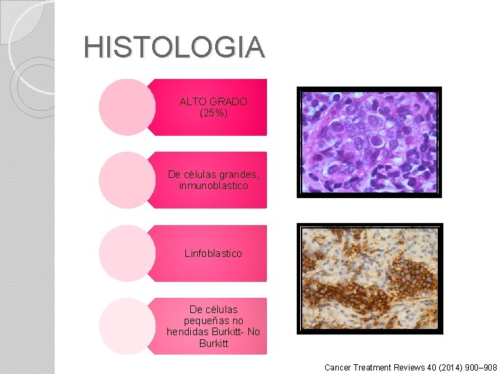 HISTOLOGIA ALTO GRADO (25%) De células grandes, inmunoblastico Linfoblastico De células pequeñas no hendidas