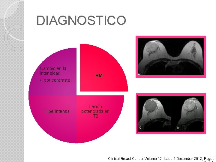 DIAGNOSTICO Cambio en la intensidad • por contraste Hiperintensa RM Lesión potenciada en T