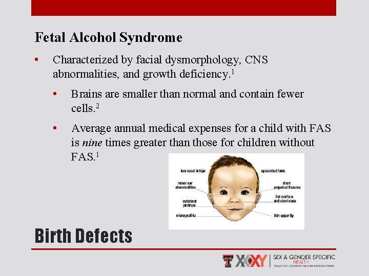 Fetal Alcohol Syndrome • Characterized by facial dysmorphology, CNS abnormalities, and growth deficiency. 1