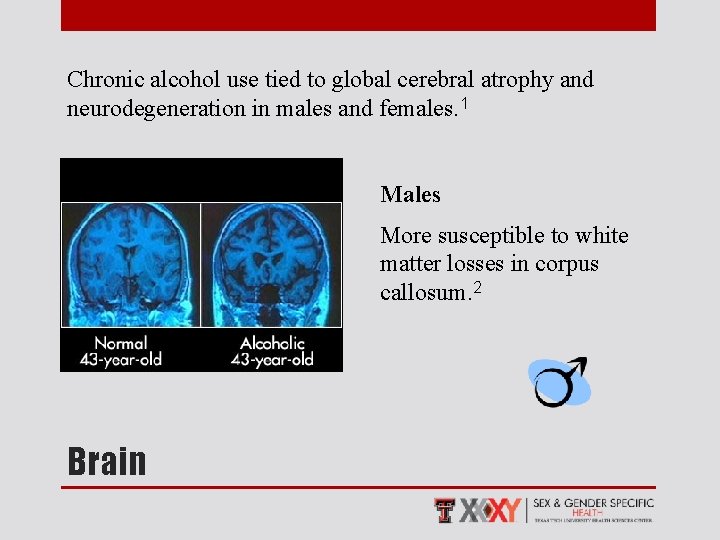 Chronic alcohol use tied to global cerebral atrophy and neurodegeneration in males and females.