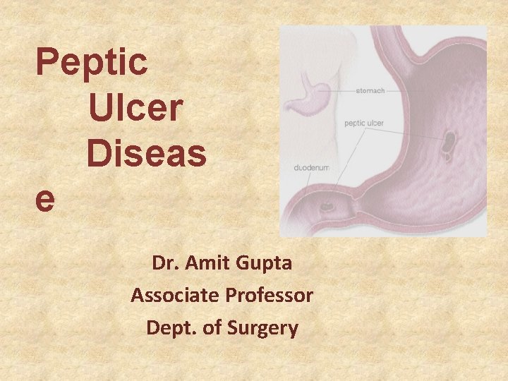 Peptic Ulcer Diseas e Dr. Amit Gupta Associate Professor Dept. of Surgery 