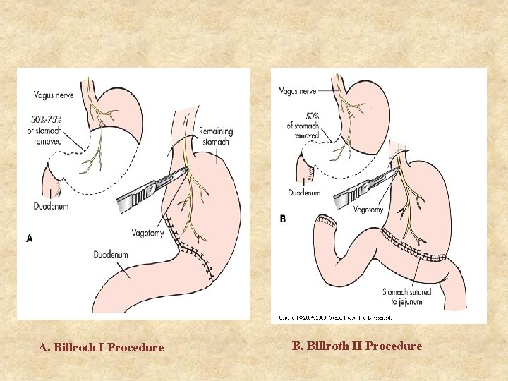 A. Billroth I Procedure B. Billroth II Procedure 