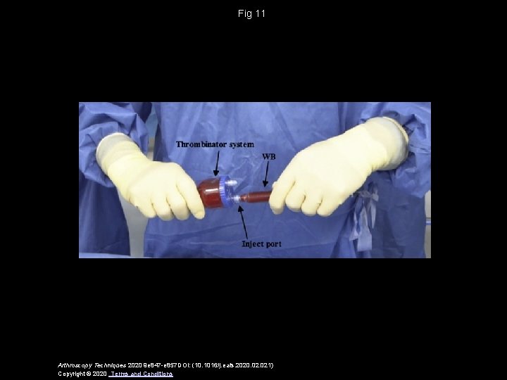 Fig 11 Arthroscopy Techniques 2020 9 e 847 -e 857 DOI: (10. 1016/j. eats.