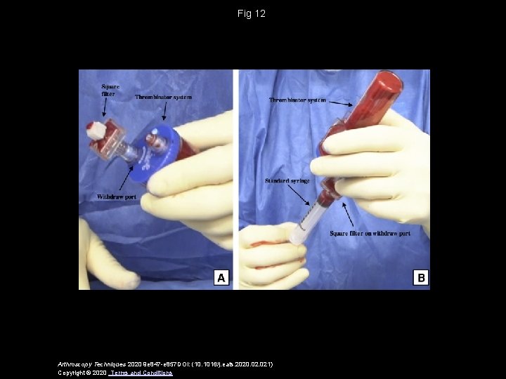 Fig 12 Arthroscopy Techniques 2020 9 e 847 -e 857 DOI: (10. 1016/j. eats.