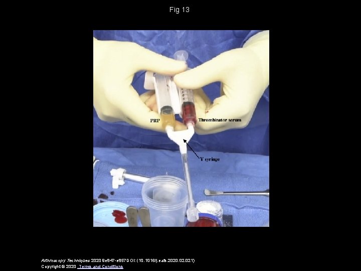 Fig 13 Arthroscopy Techniques 2020 9 e 847 -e 857 DOI: (10. 1016/j. eats.