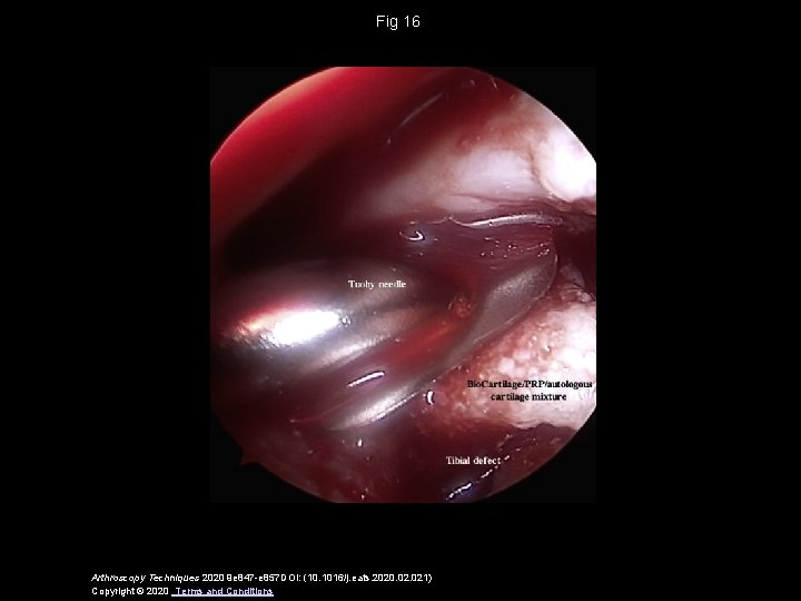 Fig 16 Arthroscopy Techniques 2020 9 e 847 -e 857 DOI: (10. 1016/j. eats.