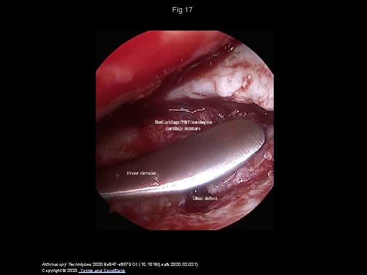 Fig 17 Arthroscopy Techniques 2020 9 e 847 -e 857 DOI: (10. 1016/j. eats.