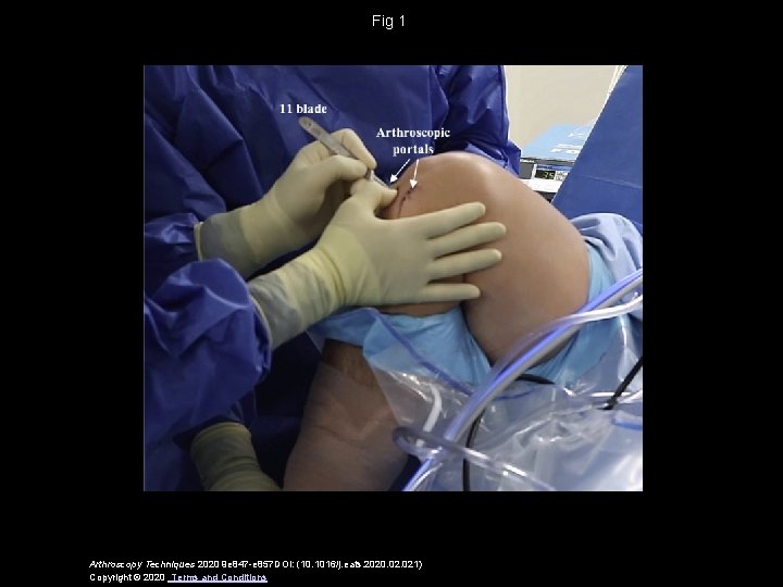 Fig 1 Arthroscopy Techniques 2020 9 e 847 -e 857 DOI: (10. 1016/j. eats.