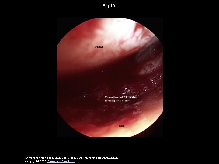 Fig 19 Arthroscopy Techniques 2020 9 e 847 -e 857 DOI: (10. 1016/j. eats.