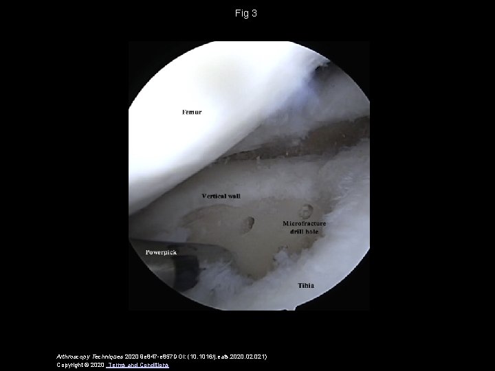 Fig 3 Arthroscopy Techniques 2020 9 e 847 -e 857 DOI: (10. 1016/j. eats.