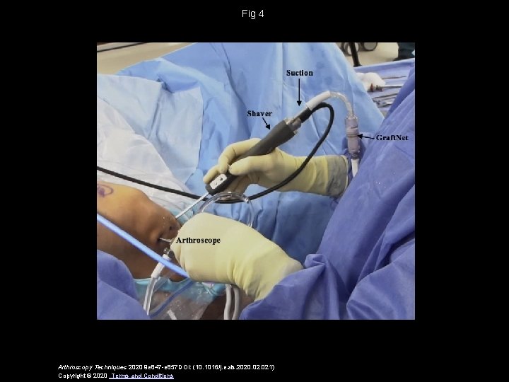 Fig 4 Arthroscopy Techniques 2020 9 e 847 -e 857 DOI: (10. 1016/j. eats.