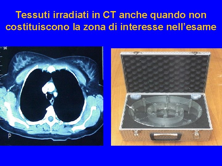 Tessuti irradiati in CT anche quando non costituiscono la zona di interesse nell’esame Lens