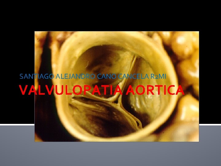 SANTIAGO ALEJANDRO CANCELA R 2 MI VALVULOPATIA AORTICA 