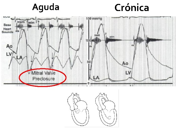 Aguda Crónica 