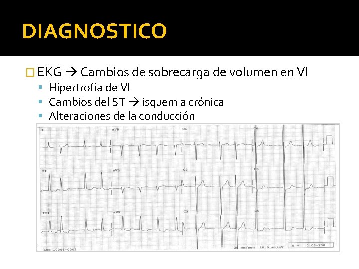 DIAGNOSTICO � EKG Cambios de sobrecarga de volumen en VI Hipertrofia de VI Cambios