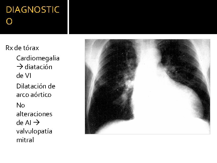 DIAGNOSTIC O Rx de tórax Cardiomegalia diatación de VI Dilatación de arco aórtico No