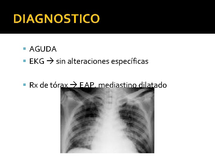 DIAGNOSTICO AGUDA EKG sin alteraciones específicas Rx de tórax EAP, mediastino dilatado 