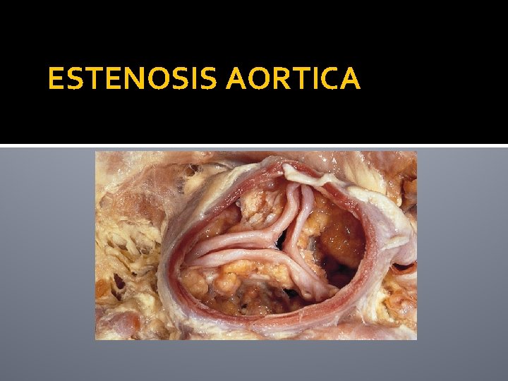 ESTENOSIS AORTICA 