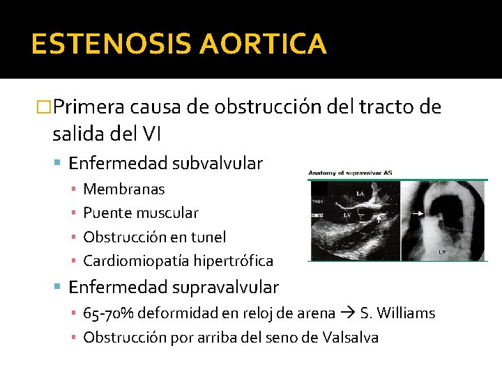 ESTENOSIS AORTICA �Primera causa de obstrucción del tracto de salida del VI Enfermedad subvalvular