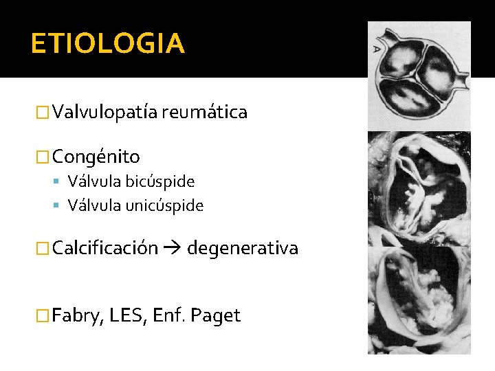ETIOLOGIA �Valvulopatía reumática �Congénito Válvula bicúspide Válvula unicúspide �Calcificación degenerativa �Fabry, LES, Enf. Paget
