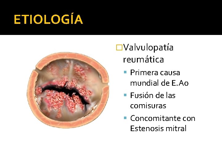 ETIOLOGÍA �Valvulopatía reumática Primera causa mundial de E. Ao Fusión de las comisuras Concomitante