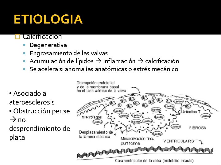 ETIOLOGIA � Calcificación Degenerativa Engrosamiento de las valvas Acumulación de lípidos inflamación calcificación Se