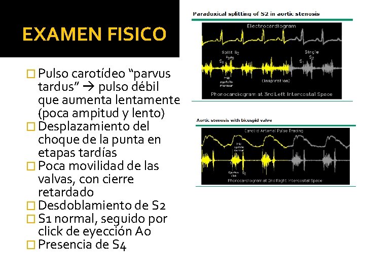EXAMEN FISICO � Pulso carotídeo “parvus tardus” pulso débil que aumenta lentamente (poca ampitud