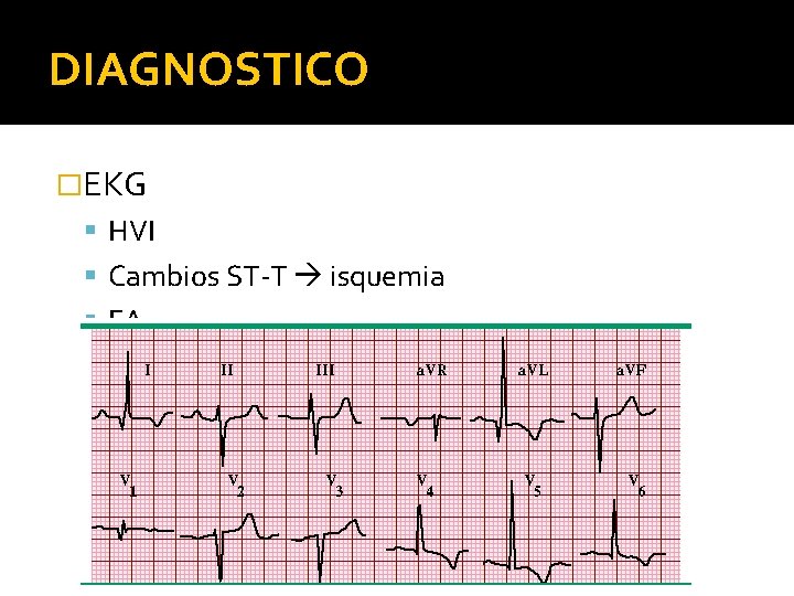 DIAGNOSTICO �EKG HVI Cambios ST-T isquemia FA 