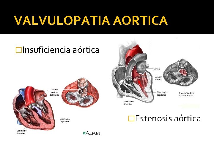 VALVULOPATIA AORTICA �Insuficiencia aórtica �Estenosis aórtica 