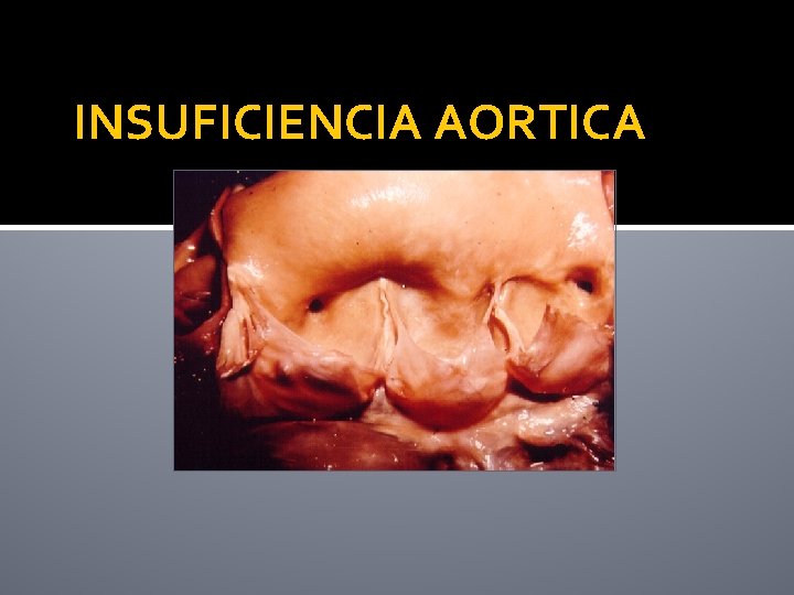 INSUFICIENCIA AORTICA 