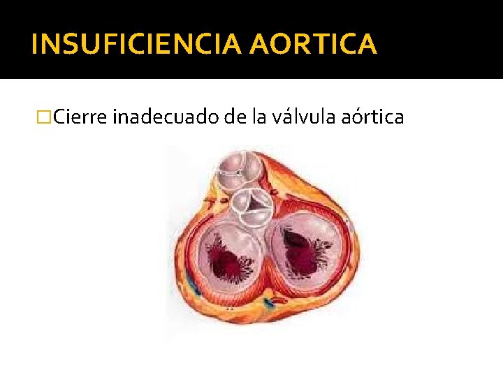 INSUFICIENCIA AORTICA �Cierre inadecuado de la válvula aórtica 