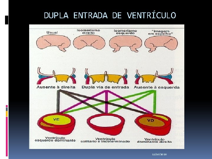 DUPLA ENTRADA DE VENTRÍCULO 11/10/2020 