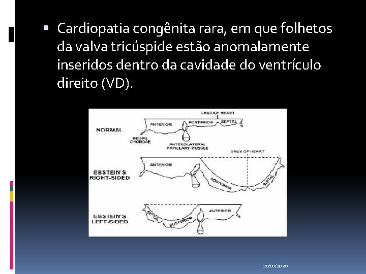  Cardiopatia congênita rara, em que folhetos da valva tricúspide estão anomalamente inseridos dentro