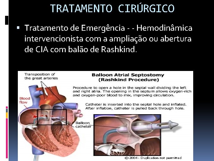 TRATAMENTO CIRÚRGICO Tratamento de Emergência - - Hemodinâmica intervencionista com a ampliação ou abertura