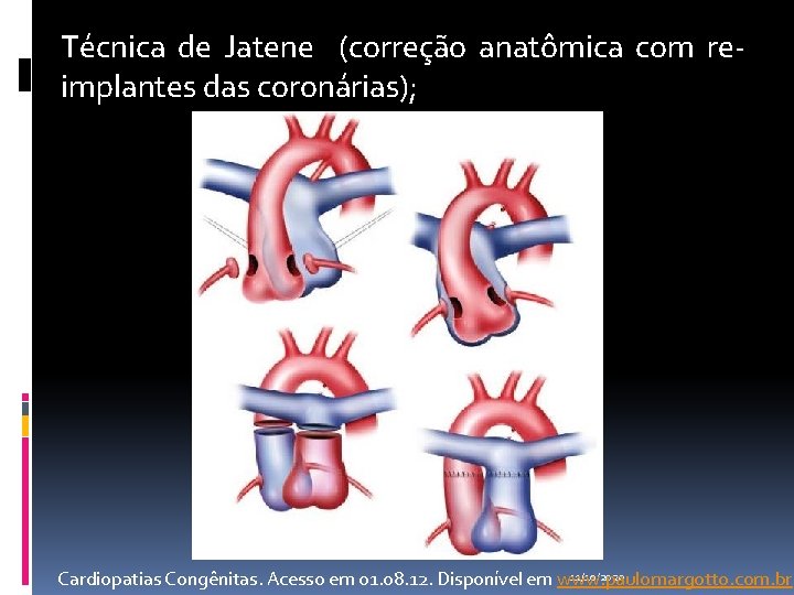 Técnica de Jatene (correção anatômica com reimplantes das coronárias); 11/10/2020 Cardiopatias Congênitas. Acesso em