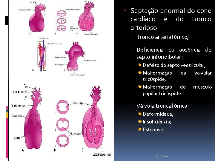  Septação anormal do cone cardíaco e do tronco arterioso Tronco arterial único; Deficiência