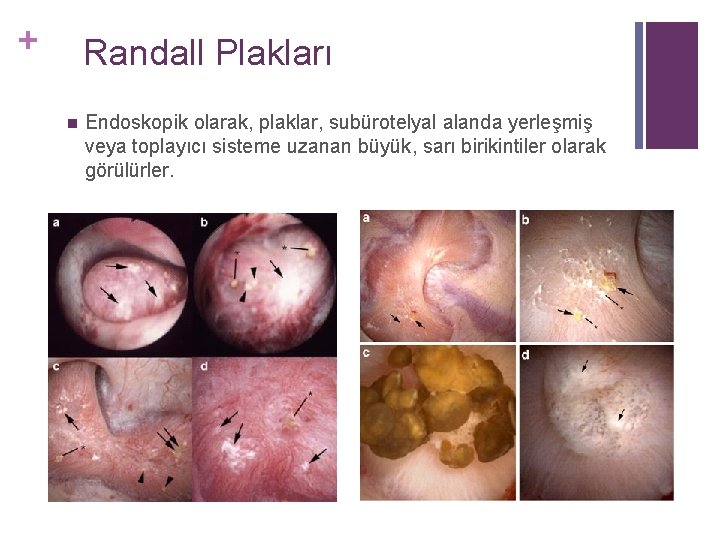 + Randall Plakları n Endoskopik olarak, plaklar, subürotelyal alanda yerleşmiş veya toplayıcı sisteme uzanan + Randall Plakları n Endoskopik olarak, plaklar, subürotelyal alanda yerleşmiş veya toplayıcı sisteme uzanan