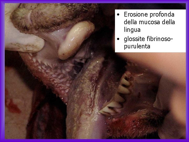  • Erosione profonda della mucosa della lingua • glossite fibrinosopurulenta 