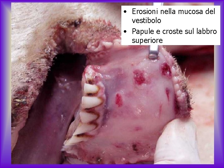  • Erosioni nella mucosa del vestibolo • Papule e croste sul labbro superiore