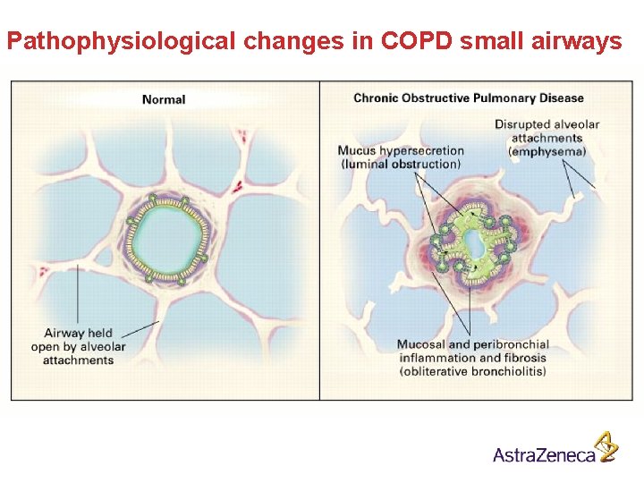 Pathophysiological changes in COPD small airways 