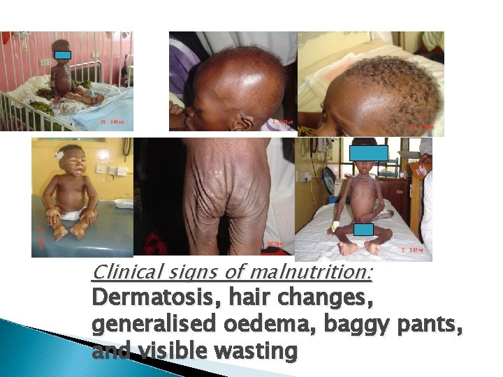Clinical signs of malnutrition: Dermatosis, hair changes, generalised oedema, baggy pants, and visible wasting