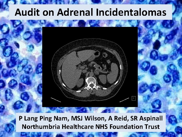 Audit on Adrenal Incidentalomas P Lang Ping Nam, MSJ Wilson, A Reid, SR Aspinall