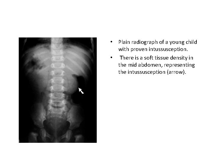  • Plain radiograph of a young child with proven intussusception. • There is