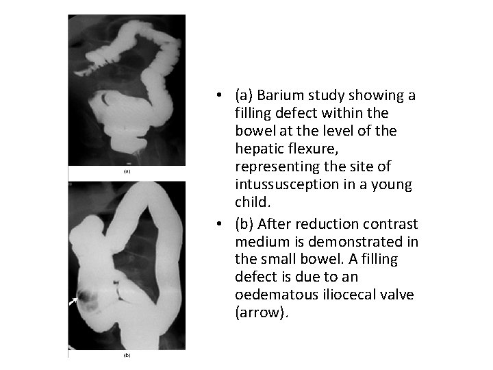  • (a) Barium study showing a filling defect within the bowel at the