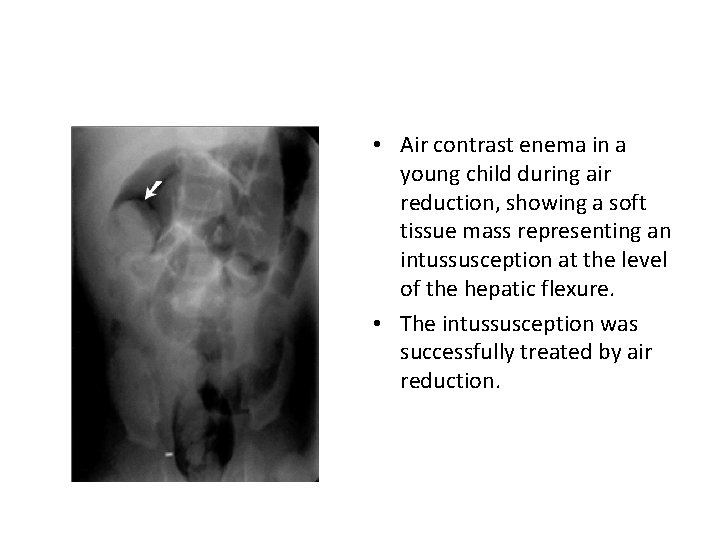  • Air contrast enema in a young child during air reduction, showing a