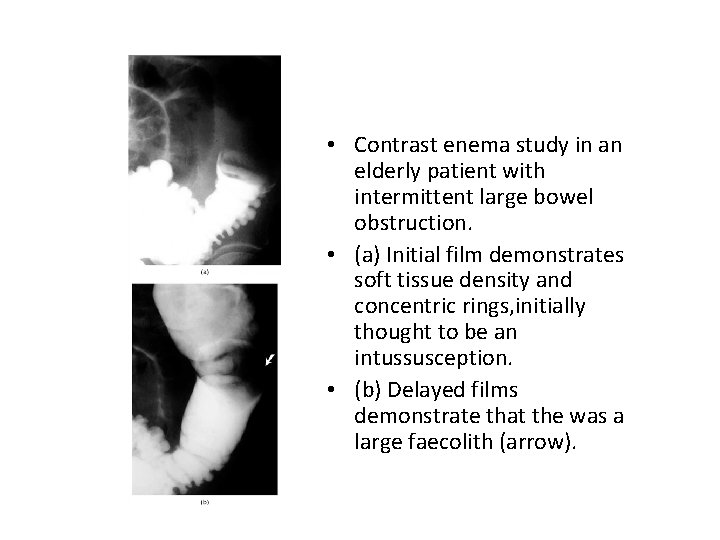  • Contrast enema study in an elderly patient with intermittent large bowel obstruction.